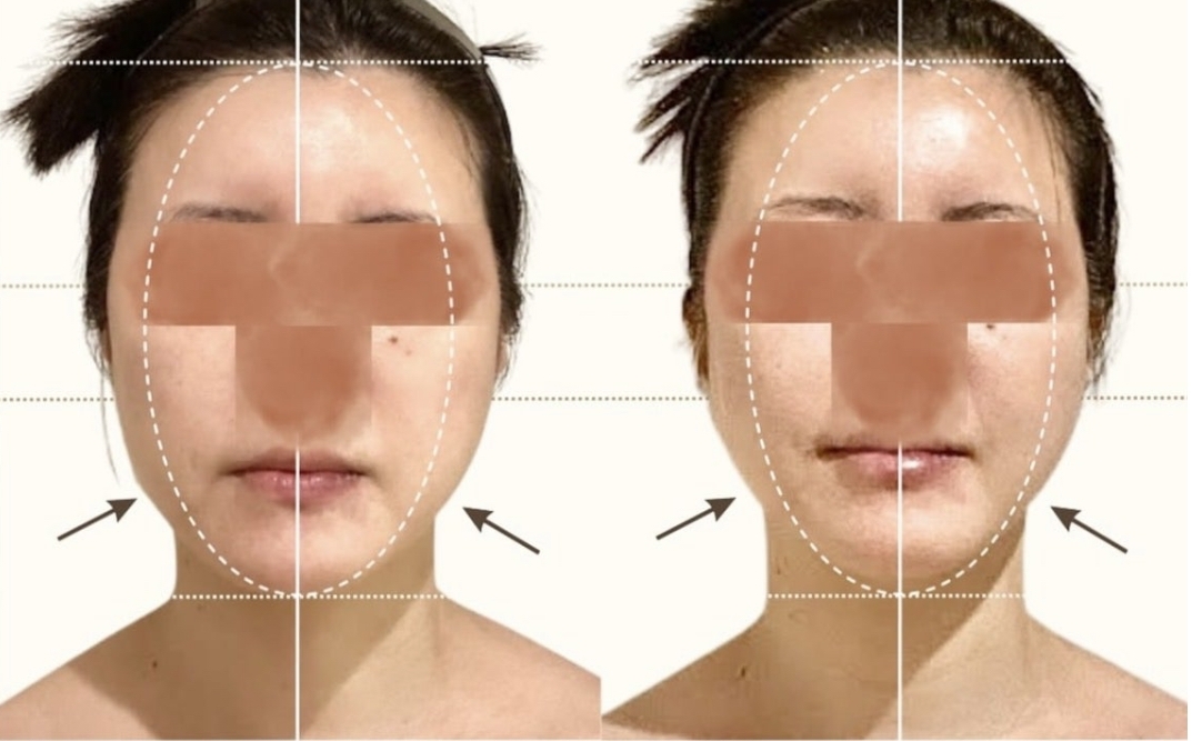 施術を受けたお客様のビフォーアフター写真