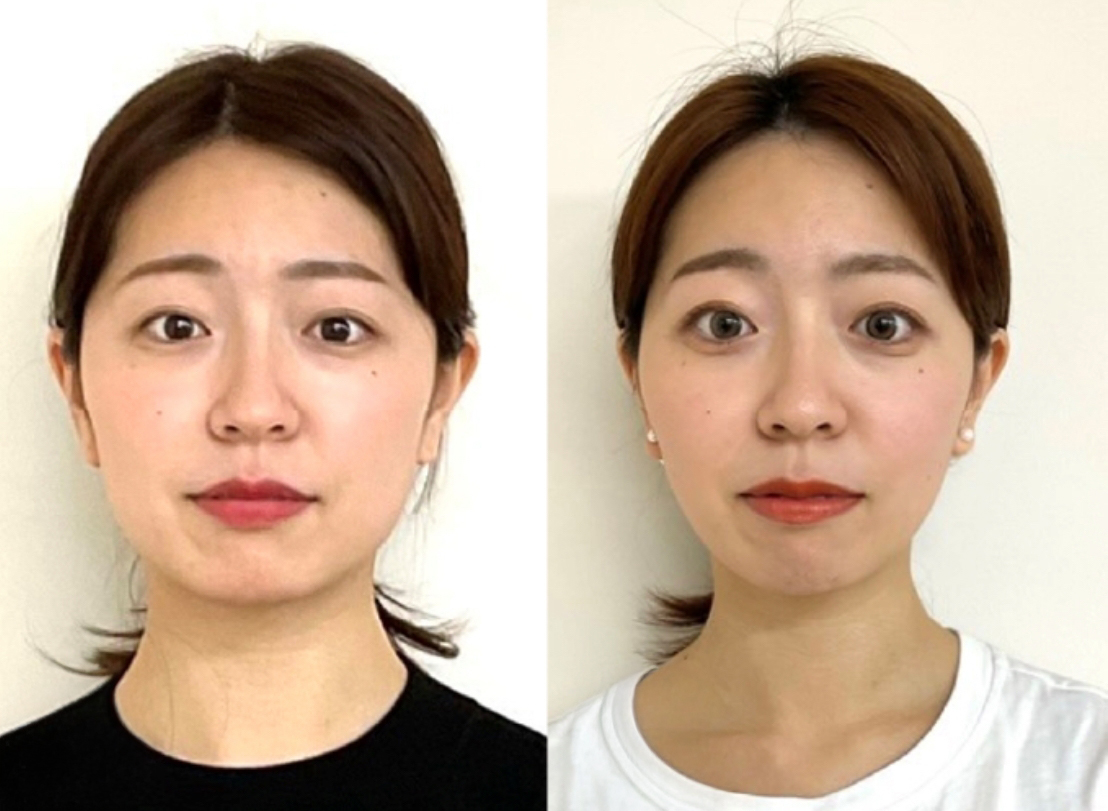 顔のビフォーアフターの写真